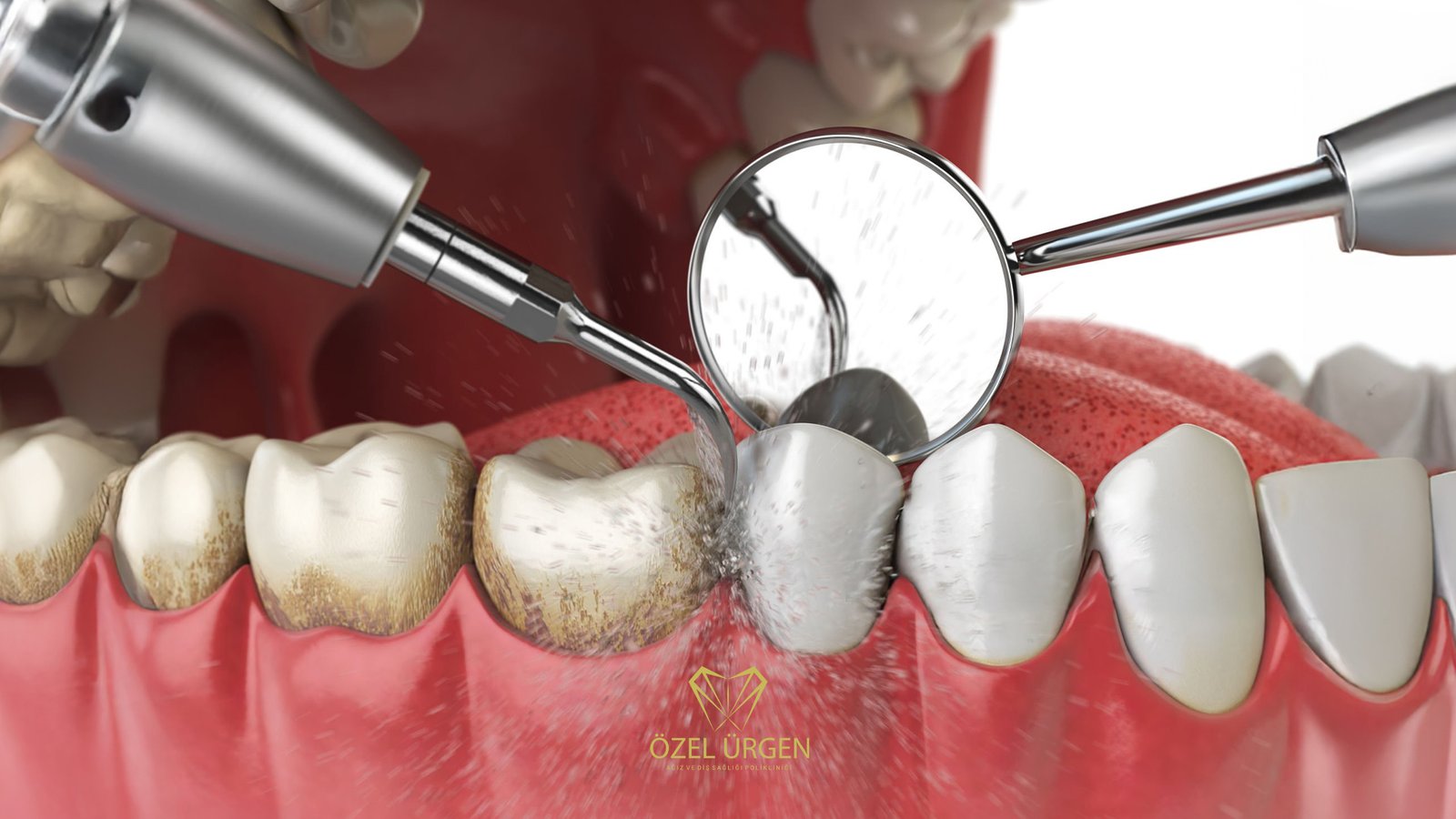 Diş Taşı Temizliği