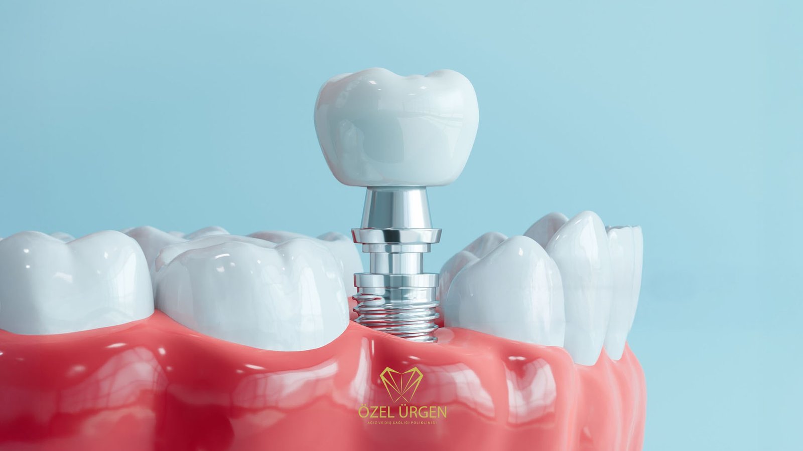 İmplant Tedavisi