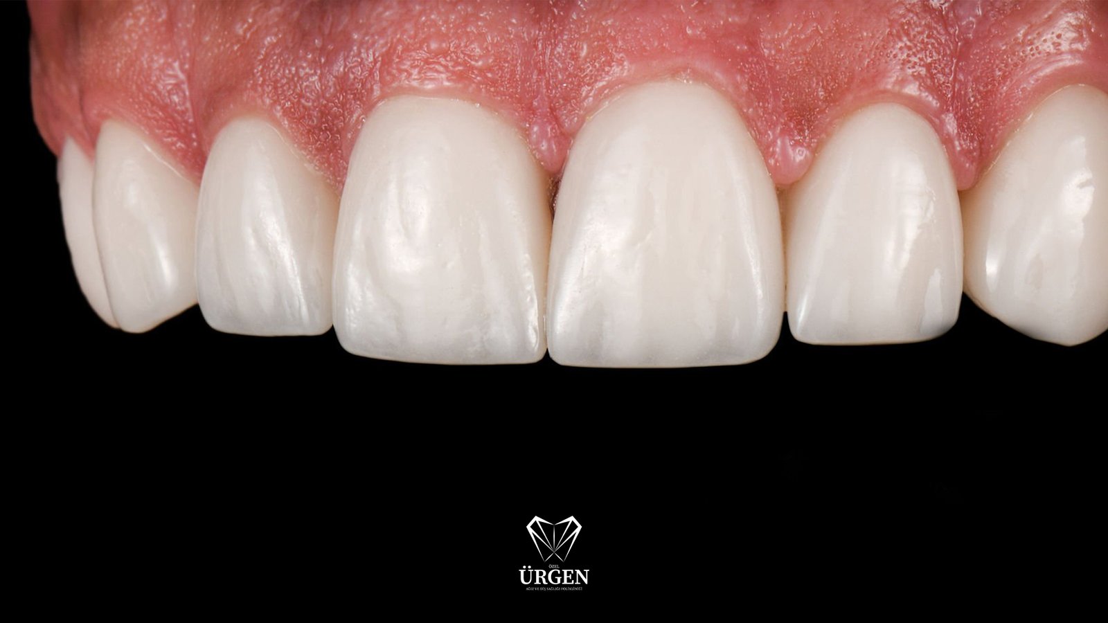 zirkonyum diş kaplama