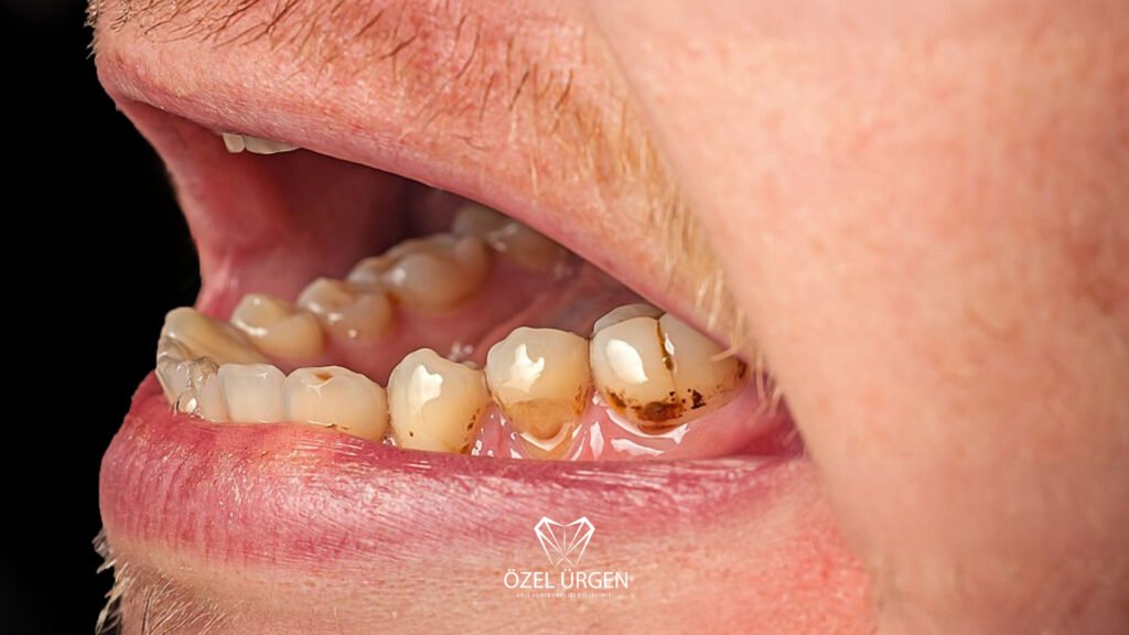 Diş Sararması Neden Olur