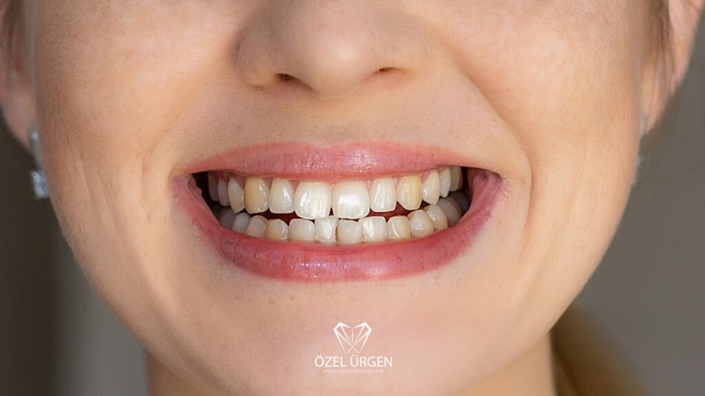 Diş Sararması Neden Olur