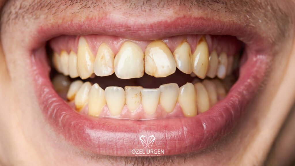 Diş Sararması Neden Olur