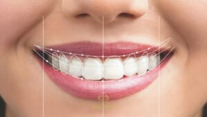 gülüş tasarımı nedir