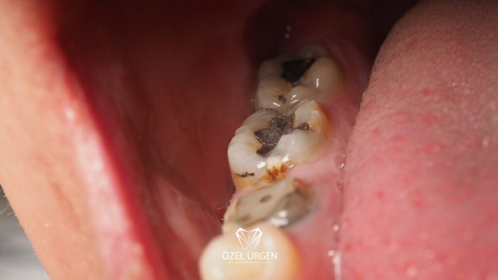 Toothache Treatment?