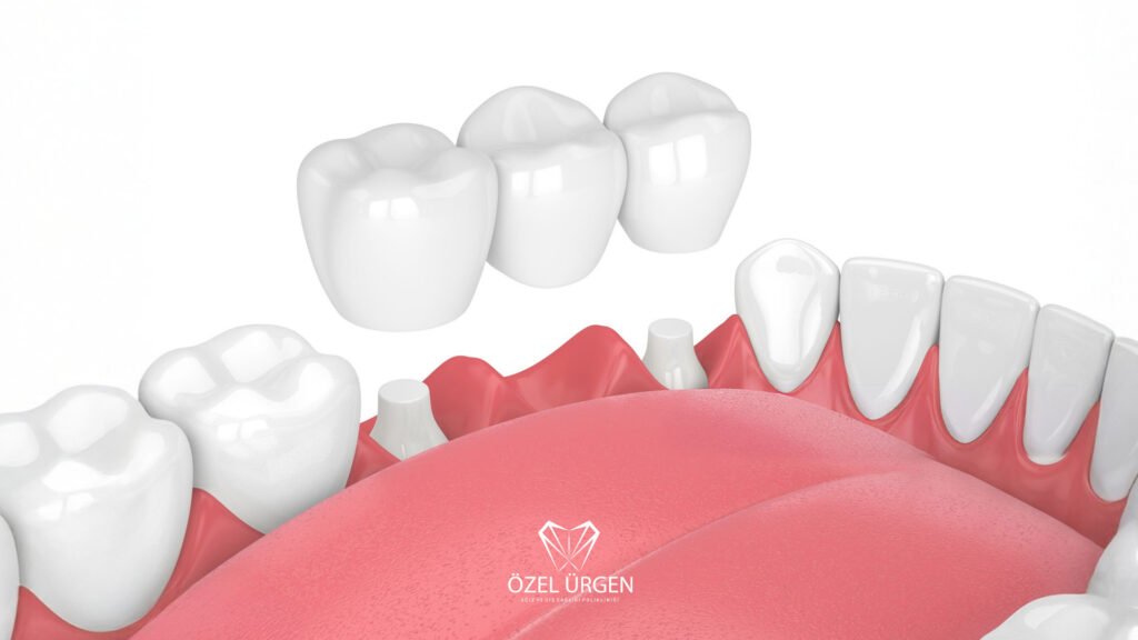 Köprü Diş Nedir