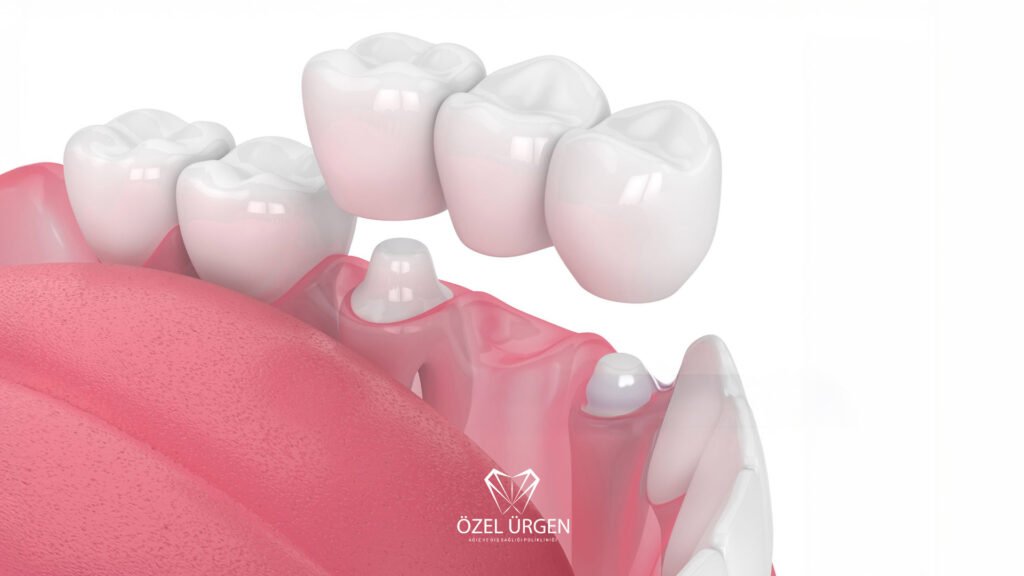 Köprü Diş Nedir