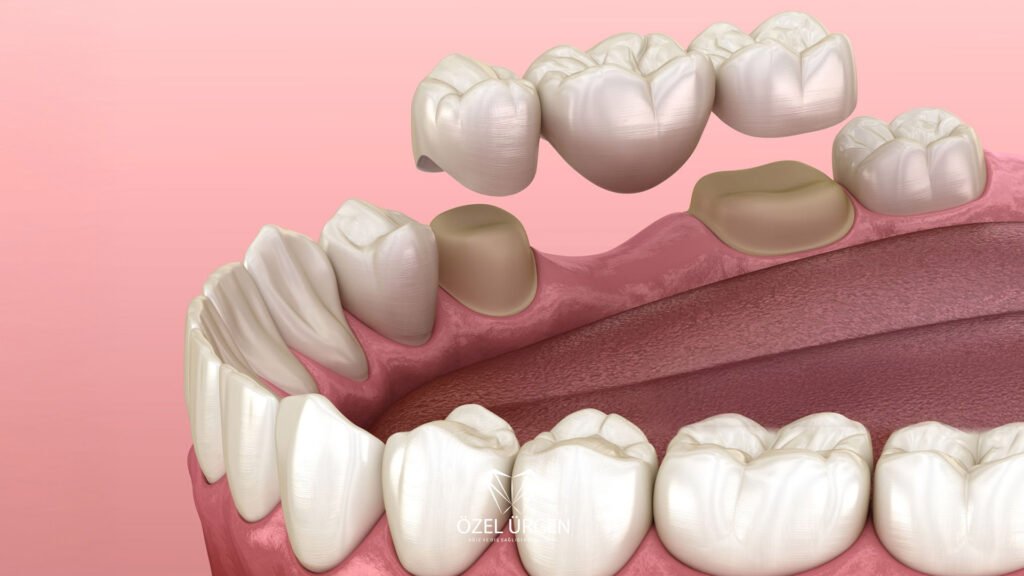 What is a Bridge Teeth
