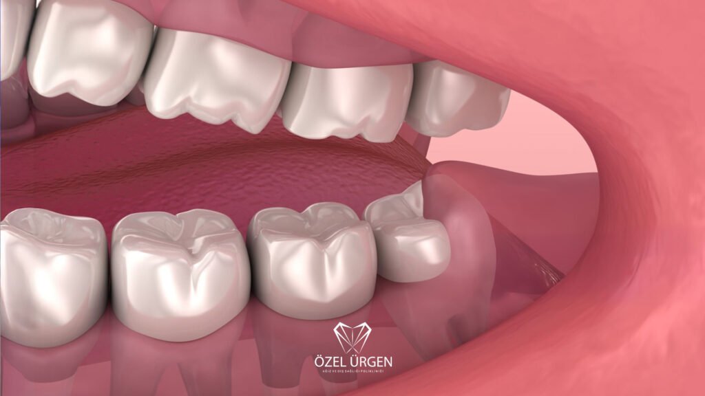 What is an Impacted Tooth