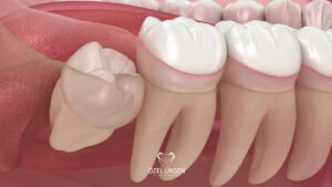 Gömülü Diş Nedir