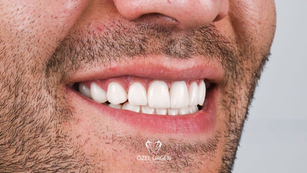 Difference Between Zirconium and Porcelain Crowns