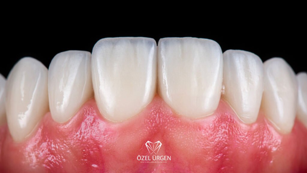 Difference Between Zirconium and Porcelain Crowns