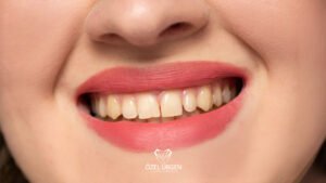 Dişlerimiz Neden Sararır