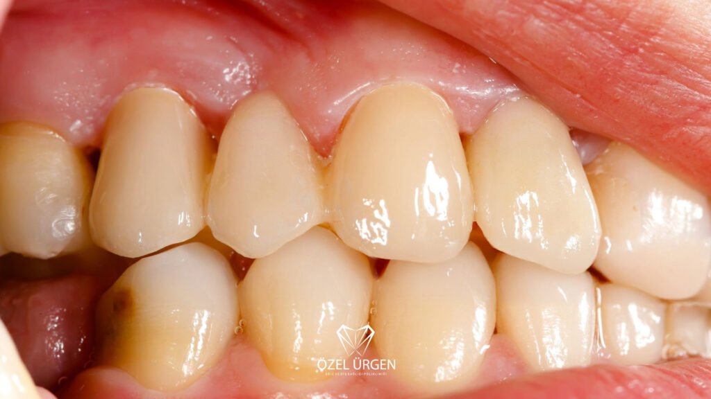 Why Do Our Teeth Turn Yellow