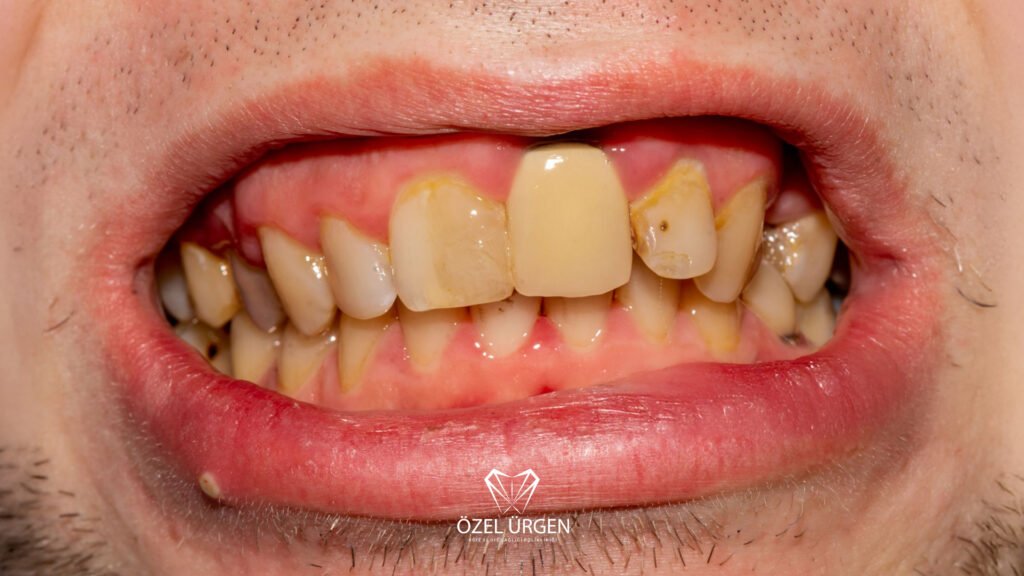 Why Do Our Teeth Turn Yellow