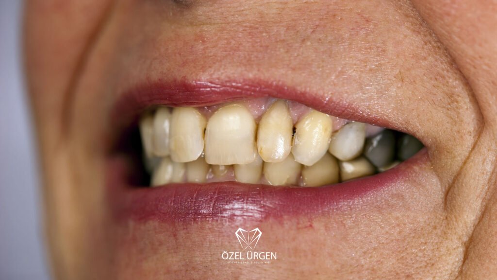 Why Do Our Teeth Turn Yellow