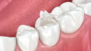 Kompozit Dolgu Nedir