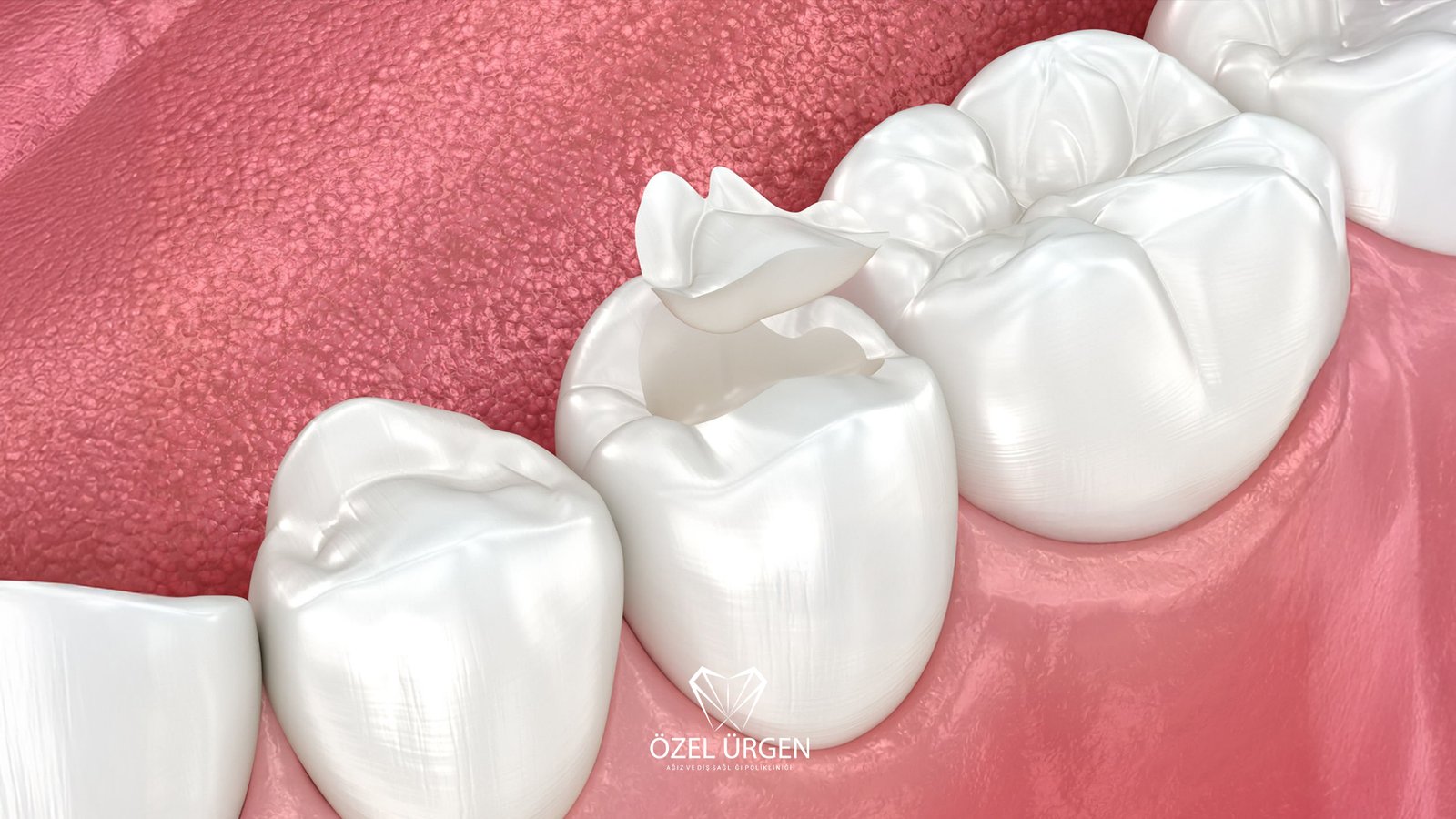 Kompozit Dolgu Nedir