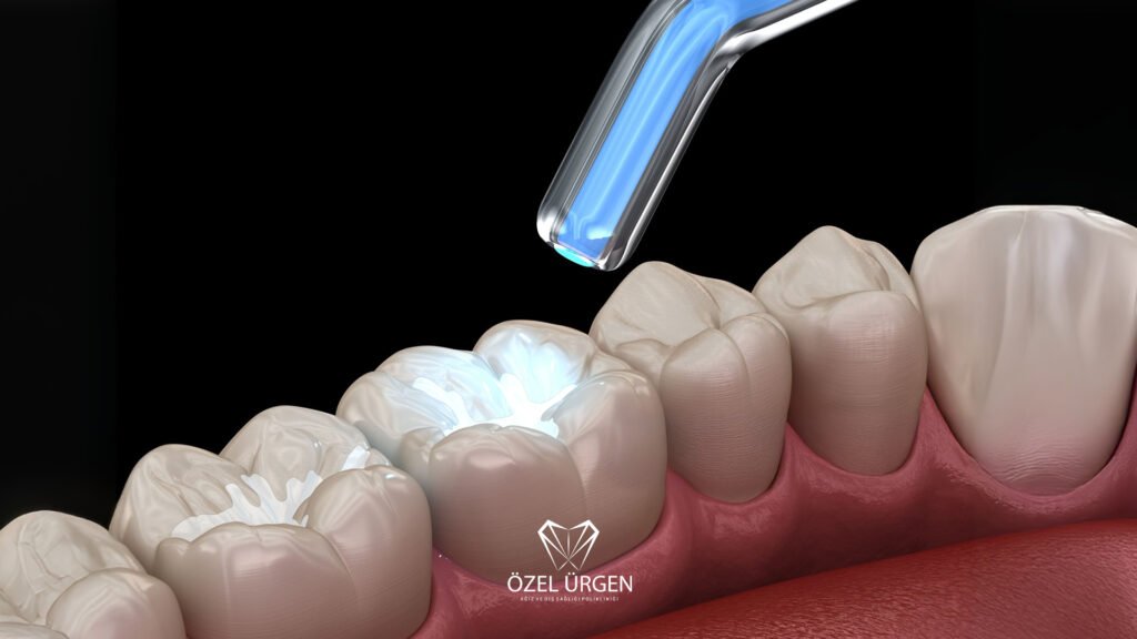 What Is a Composite Filling