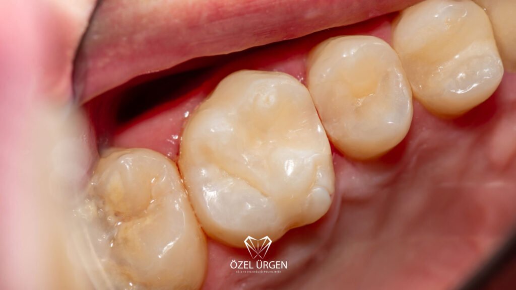 Kompozit Dolgu Nedir