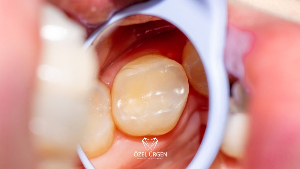 What Is a Composite Filling