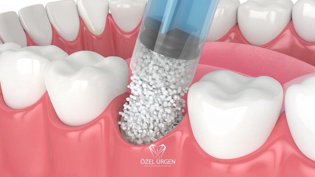 What Is Bone Graft