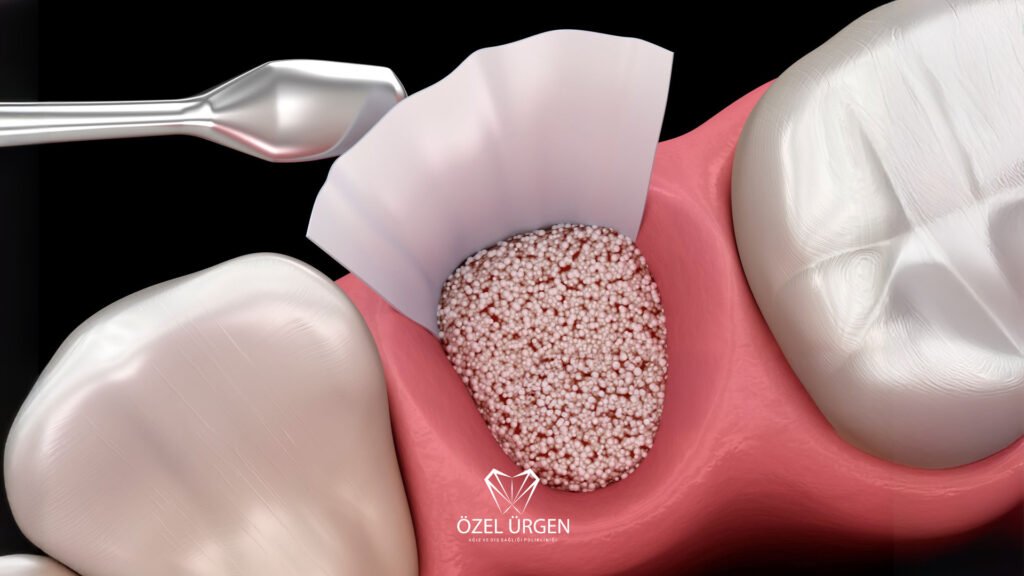 What Is Bone Graft