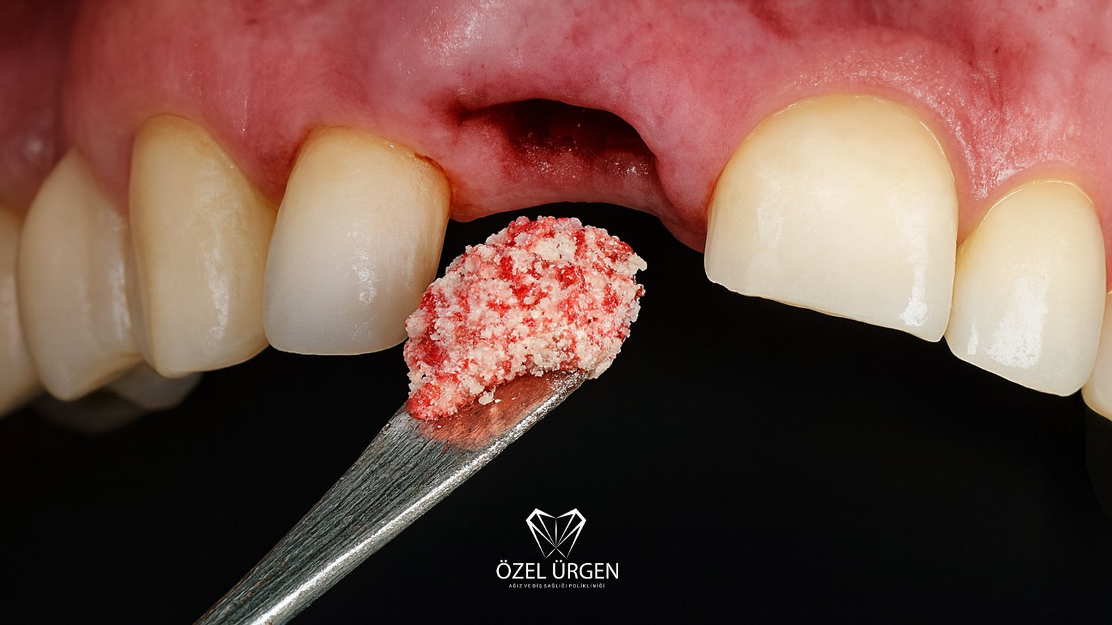 Kemik Tozu Tedavisi Nedir