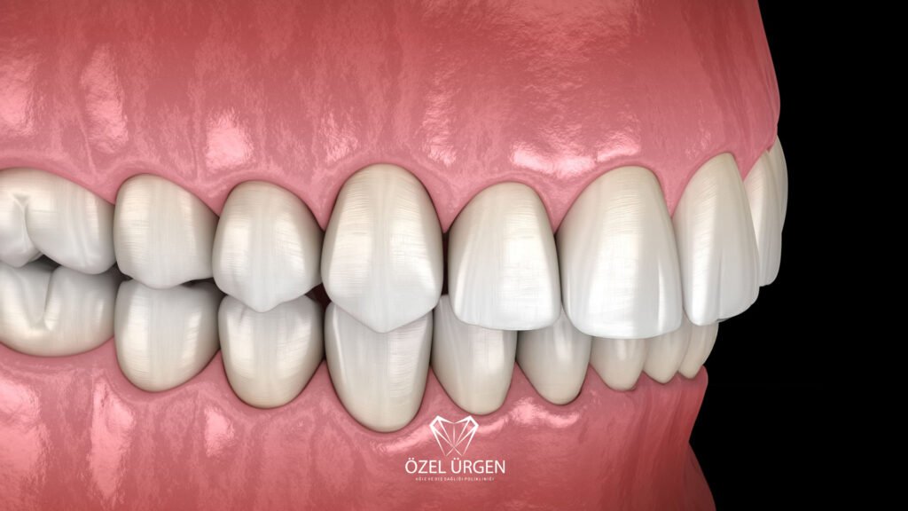 Overbite Nedir? Tedavisi Nasıldır?