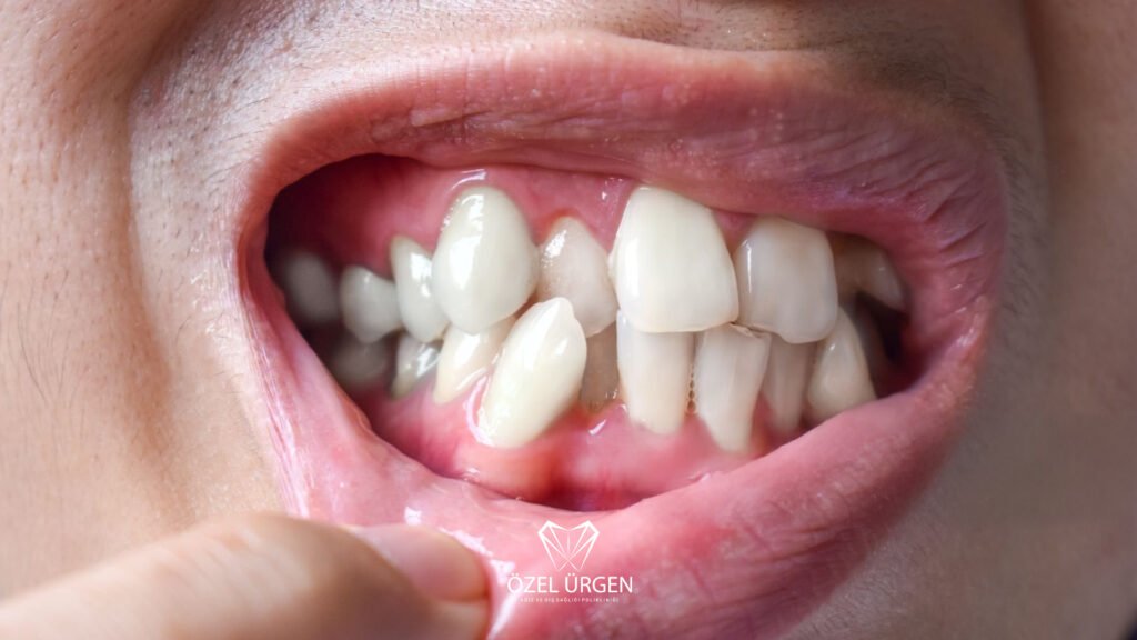 Overbite Nedir? Tedavisi Nasıldır?