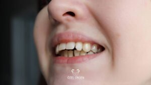 Overbite Nedir? Tedavisi Nasıldır?