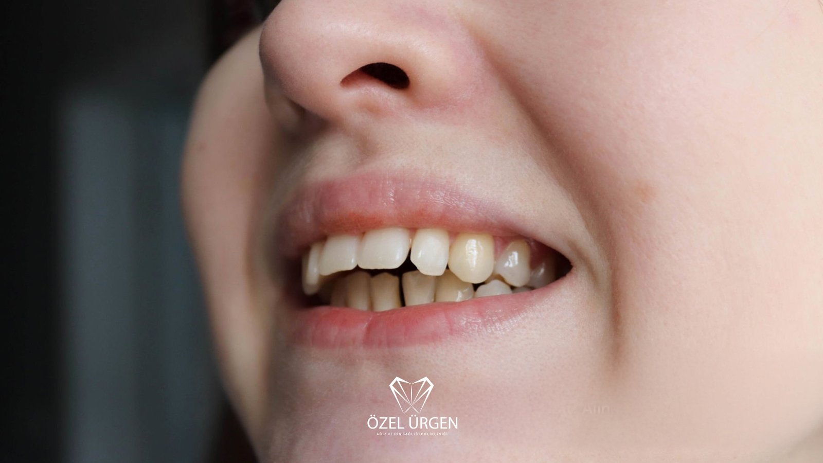 Overbite Nedir? Tedavisi Nasıldır?