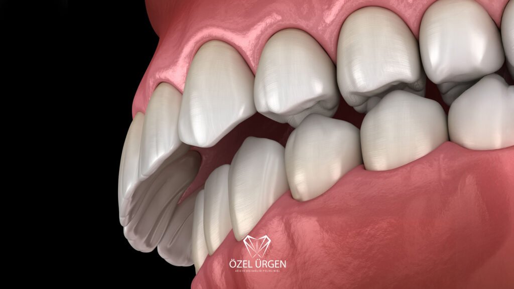 Overbite Nedir? Tedavisi Nasıldır?