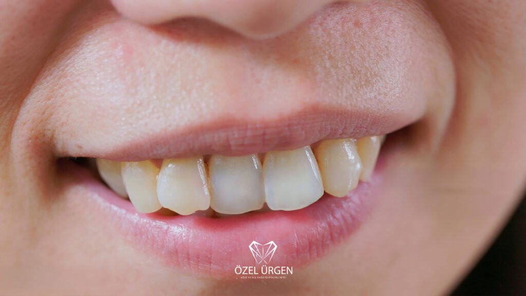 Diş Minesi Aşınması 