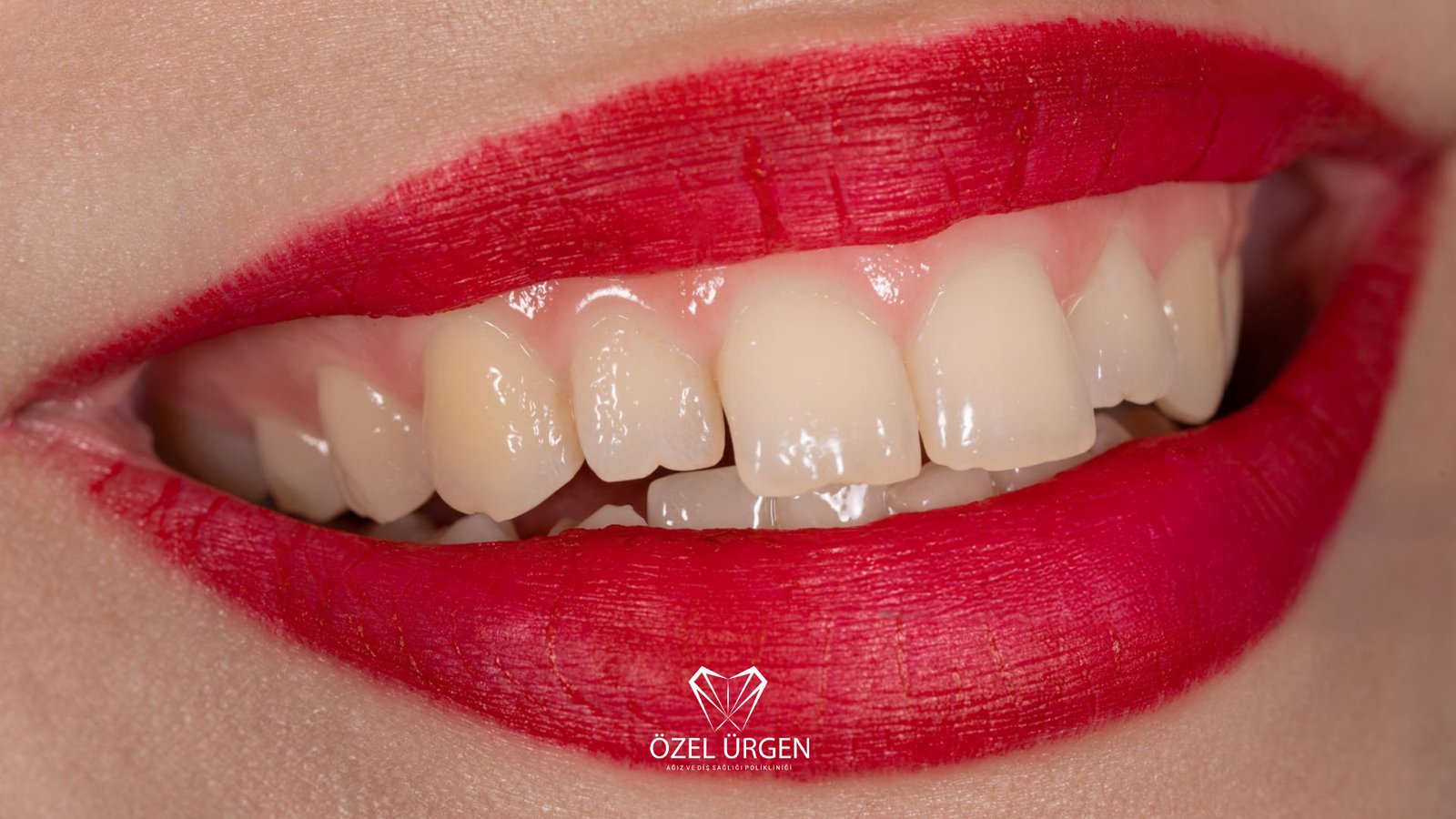 Diş Minesi Aşınması