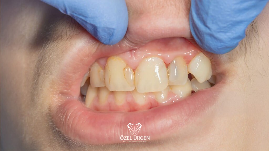 Diş Minesi Aşınması 