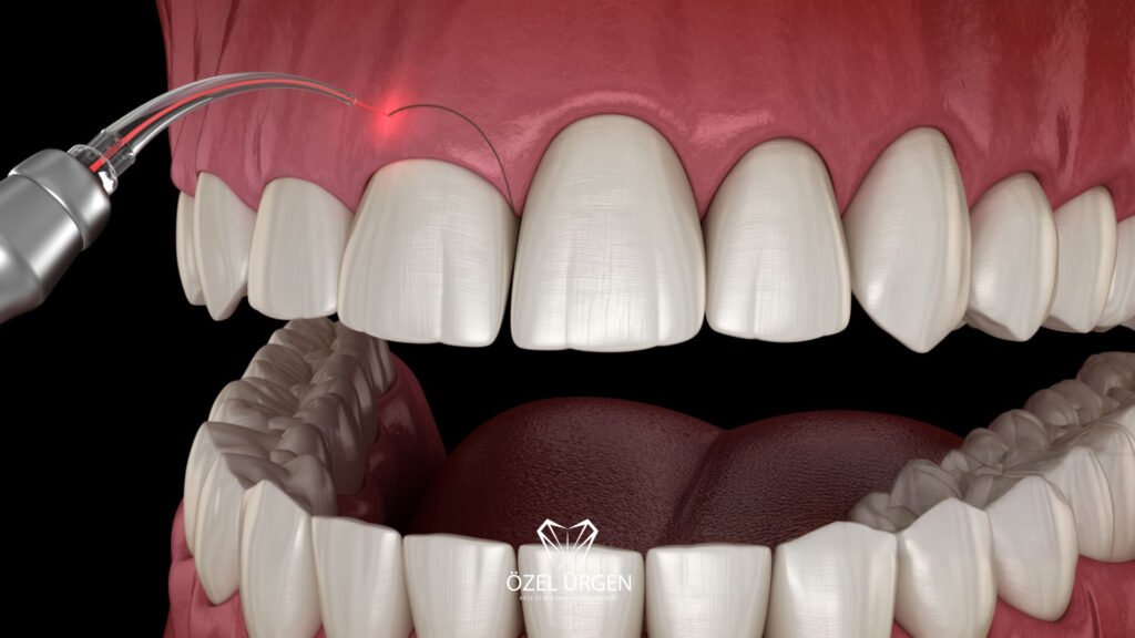 What Is Gingivectomy