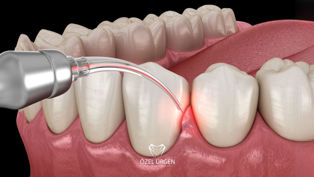 What Is Gingivectomy