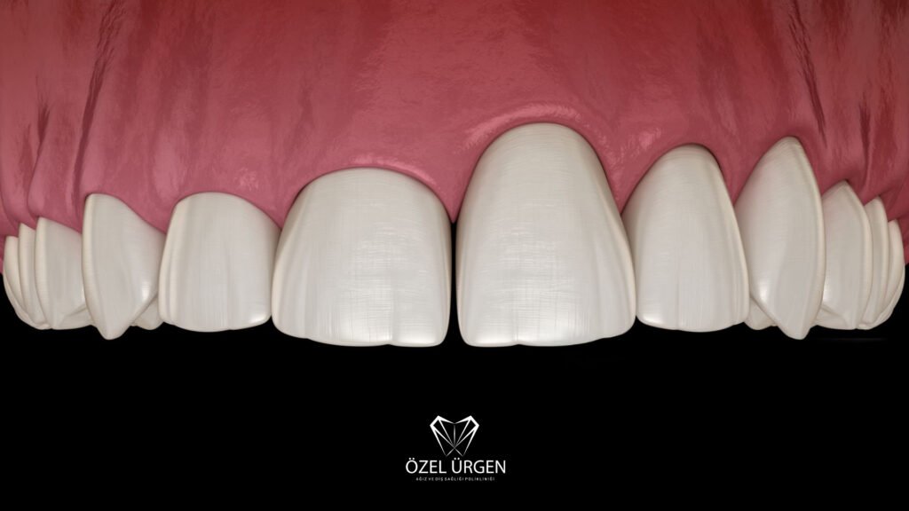 What Is Gingivectomy