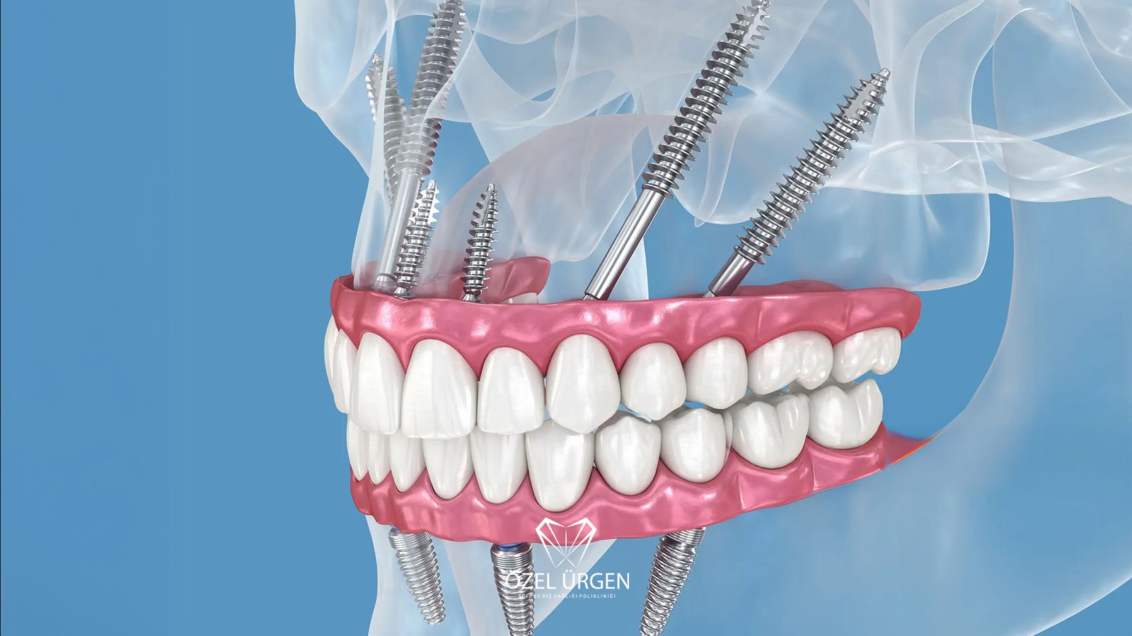 Zigoma İmplant Nedir