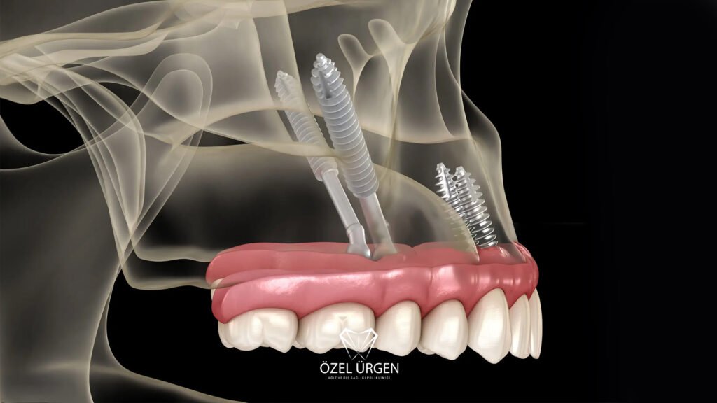 What Is a Zygoma Implant