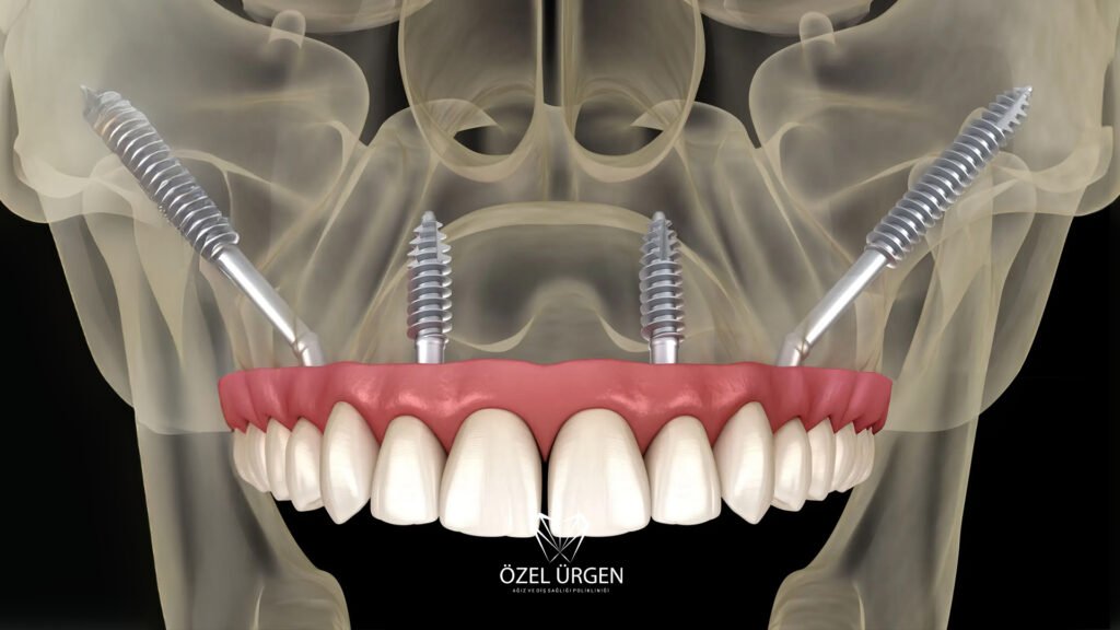 Zigoma İmplant Nedir