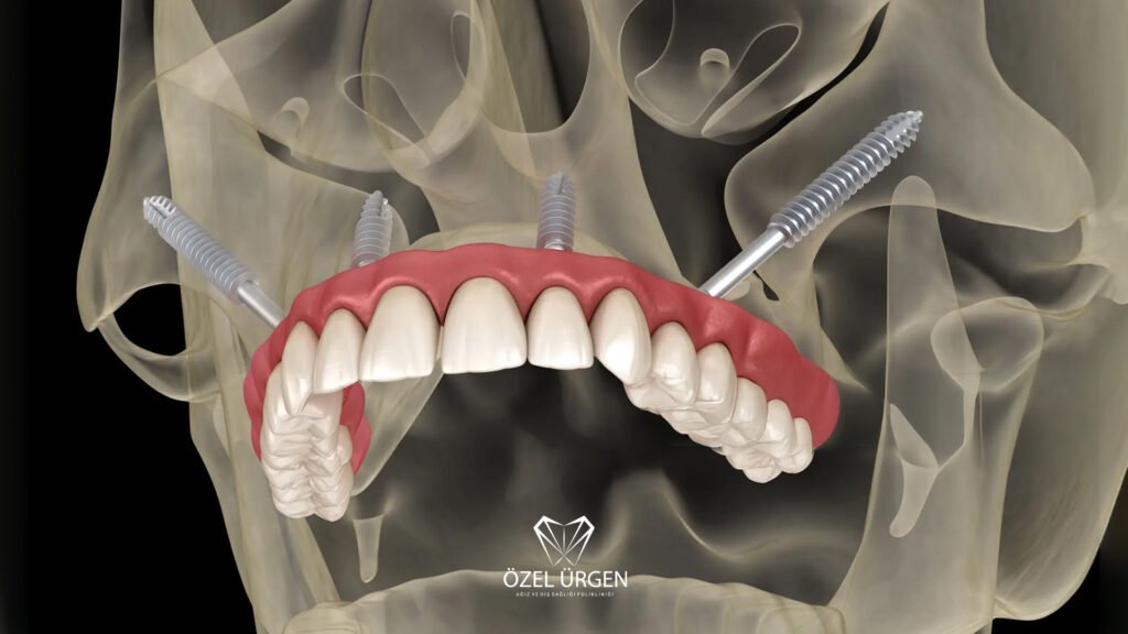 What Is a Zygoma Implant