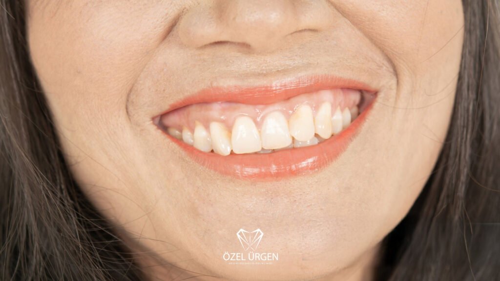 Gummy Smile Nedir