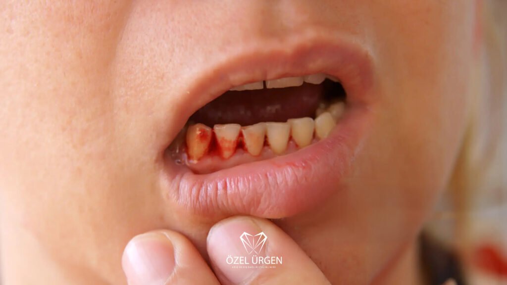 Causes of Gum Bleeding