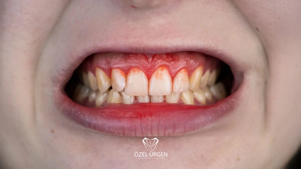 Causes of Gum Bleeding
