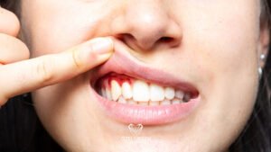 Diş Eti Kanaması Nedenleri