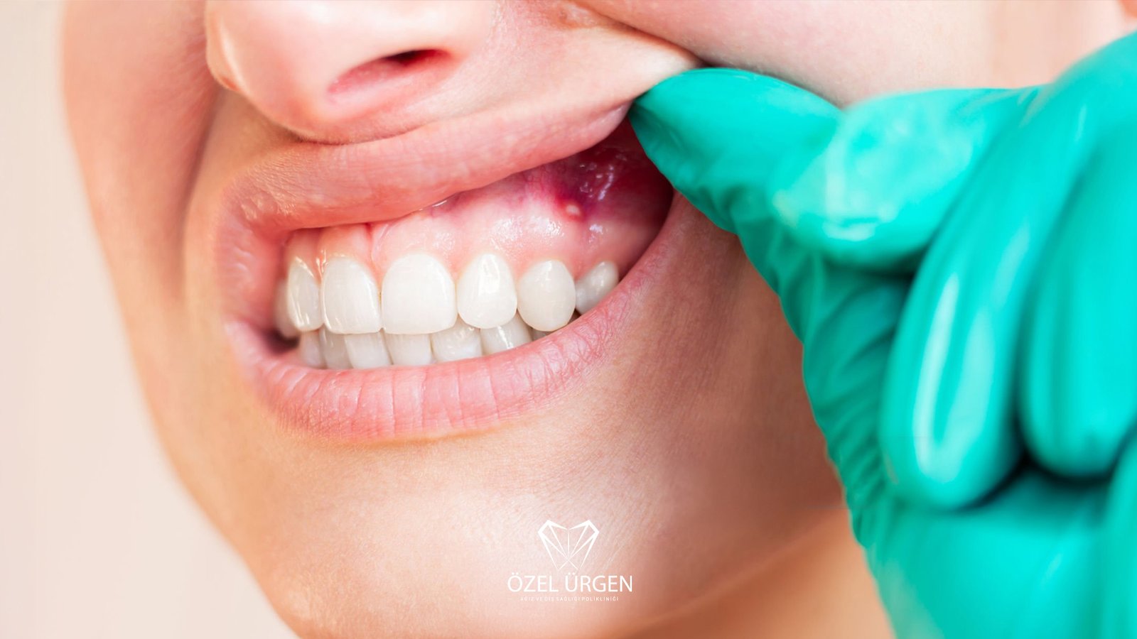 Diş Eti Yarası Sebepleri