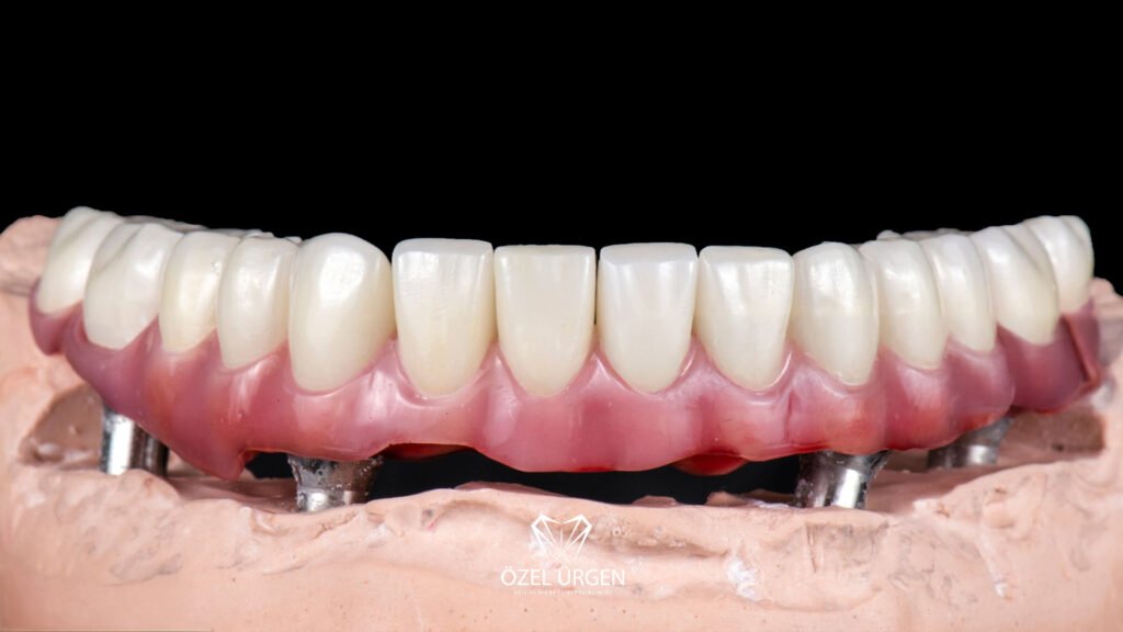 İmplant Üstü Protez Nedir?