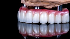 İmplant Üstü Protez Nedir?