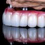 Implant Ustu Protez Nedir_ 2 90x90